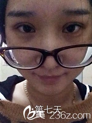 做部分切開法雙眼皮之后