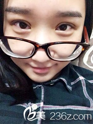 做部分切開法雙眼皮之后