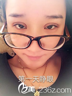 做部分切開法雙眼皮之后