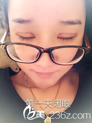 做部分切開法雙眼皮之后