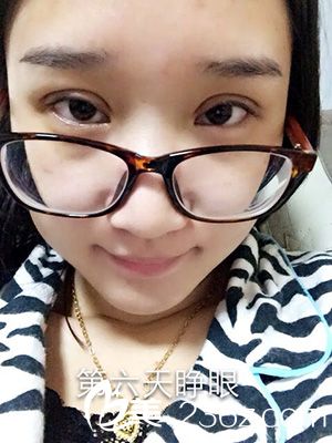 做部分切開法雙眼皮之后