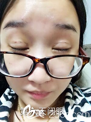 做部分切開法雙眼皮之后