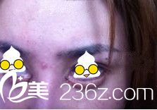 自體脂肪營造臥蠶之后