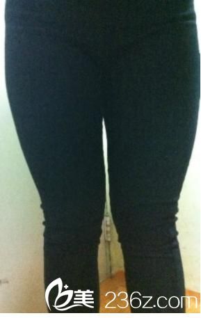 吸脂瘦大腿之前