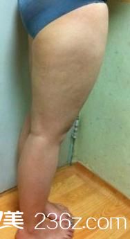吸脂瘦大腿之前