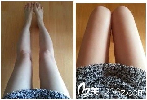 吸脂瘦大腿