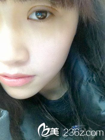 部分切開法雙眼皮