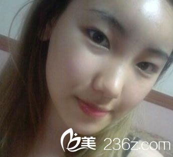 自體脂肪豐額頭