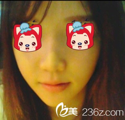 V-line瓜子臉整形