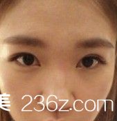 鼻孔聚集法鼻翼縮小