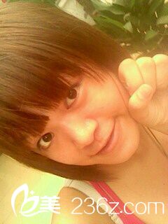 埋線(xiàn)雙眼皮