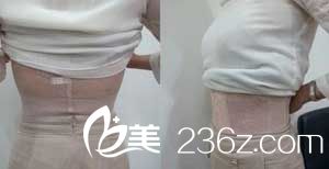 吸脂瘦腹部