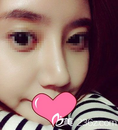 臉部自體脂肪移植