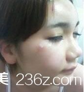 玻尿酸營造臥蠶