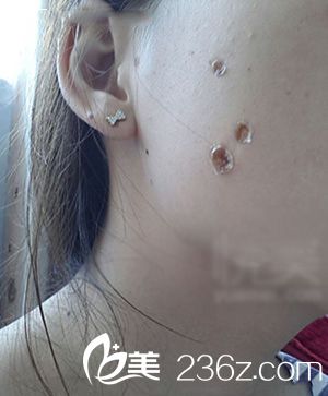 激光點(diǎn)痣