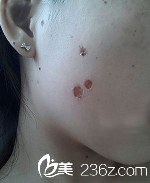 激光點(diǎn)痣