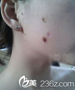 激光點(diǎn)痣