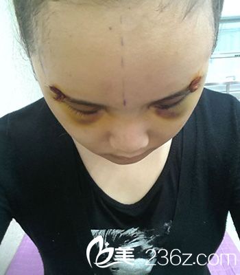 術(shù)后恢復(fù)