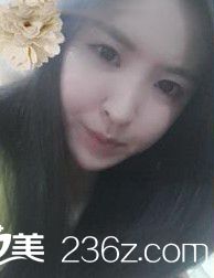 臉部自體脂肪移植