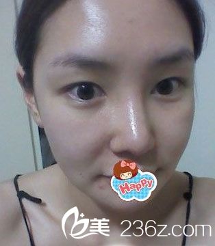 假體植入墊下巴