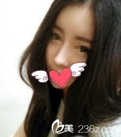 臉部自體脂肪移植