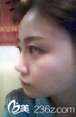 自體脂肪移植豐額頭