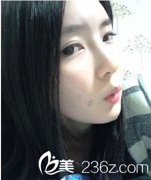 假體植入豐額頭