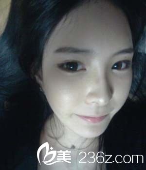 假體植入豐額頭