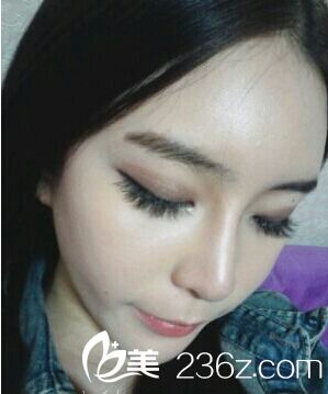 假體植入豐額頭