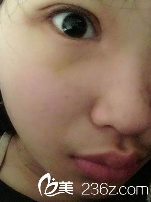 術(shù)后恢復(fù)