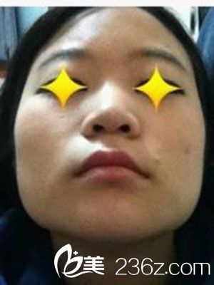 v-line瓜子臉手術(shù)