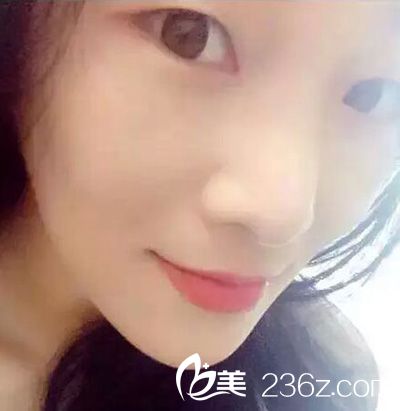 部分切開法雙眼皮