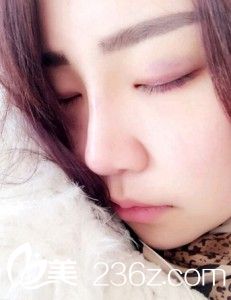 鼻翼軟骨縫合手術(shù)