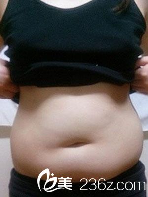 吸脂瘦腹部