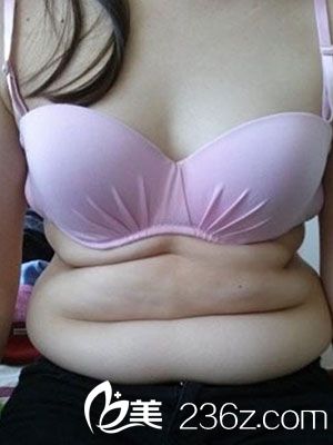 吸脂瘦腹部