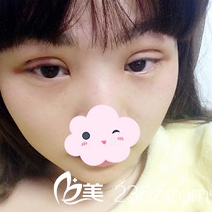 埋線(xiàn)雙眼皮