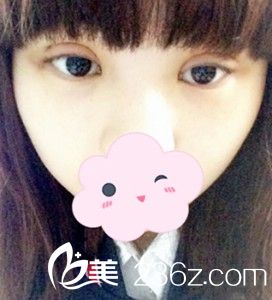 埋線(xiàn)雙眼皮