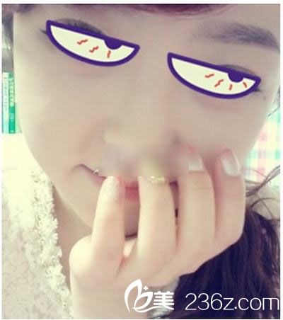 V-line瓜子臉手術(shù)