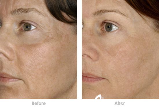 玻尿酸除皺多少錢 玻尿酸注射除皺價(jià)格