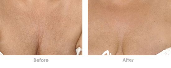 玻尿酸除皺多少錢 玻尿酸注射除皺價(jià)格