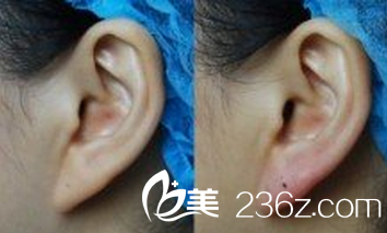 耳垂縮小術(shù)