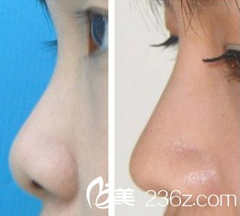 蒜頭鼻整形前后對(duì)比圖
