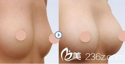 自體脂肪隆胸手術(shù)前后對(duì)比圖