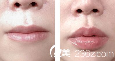 注射玻尿酸豐唇多少錢一針