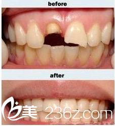 烤瓷牙修復(fù)前后對比圖