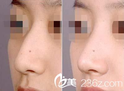 鼻梁矯正多少錢