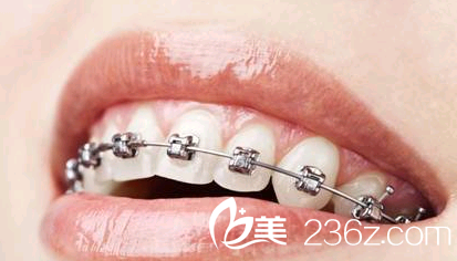 牙齒矯正術(shù)后會(huì)有哪些問(wèn)題