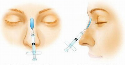 全盤解析隆鼻手術(shù) 讓隆鼻不再迷霧重重