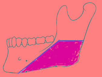 磨下頜角 風(fēng)險到底有多大？