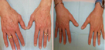 你的自體脂肪能“搬”到哪兒？